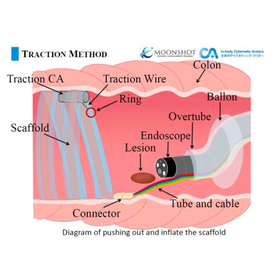 東北大学技術：内視鏡治療用牽引システム：T24-072
