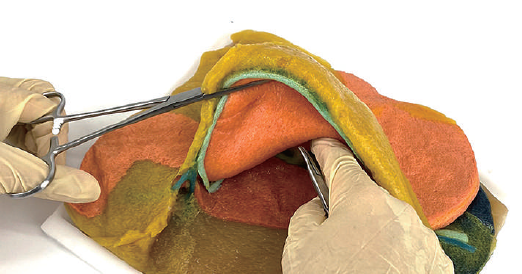 VTT胃切除モデル