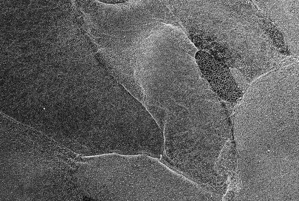 【解析事例】角膜上皮（SEM）