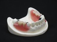 ノンクラスプデンチャー