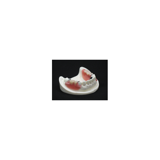 ?ノンクラスプデンチャー 画像.png