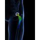 Medical_Design_Hip replacement.jpg